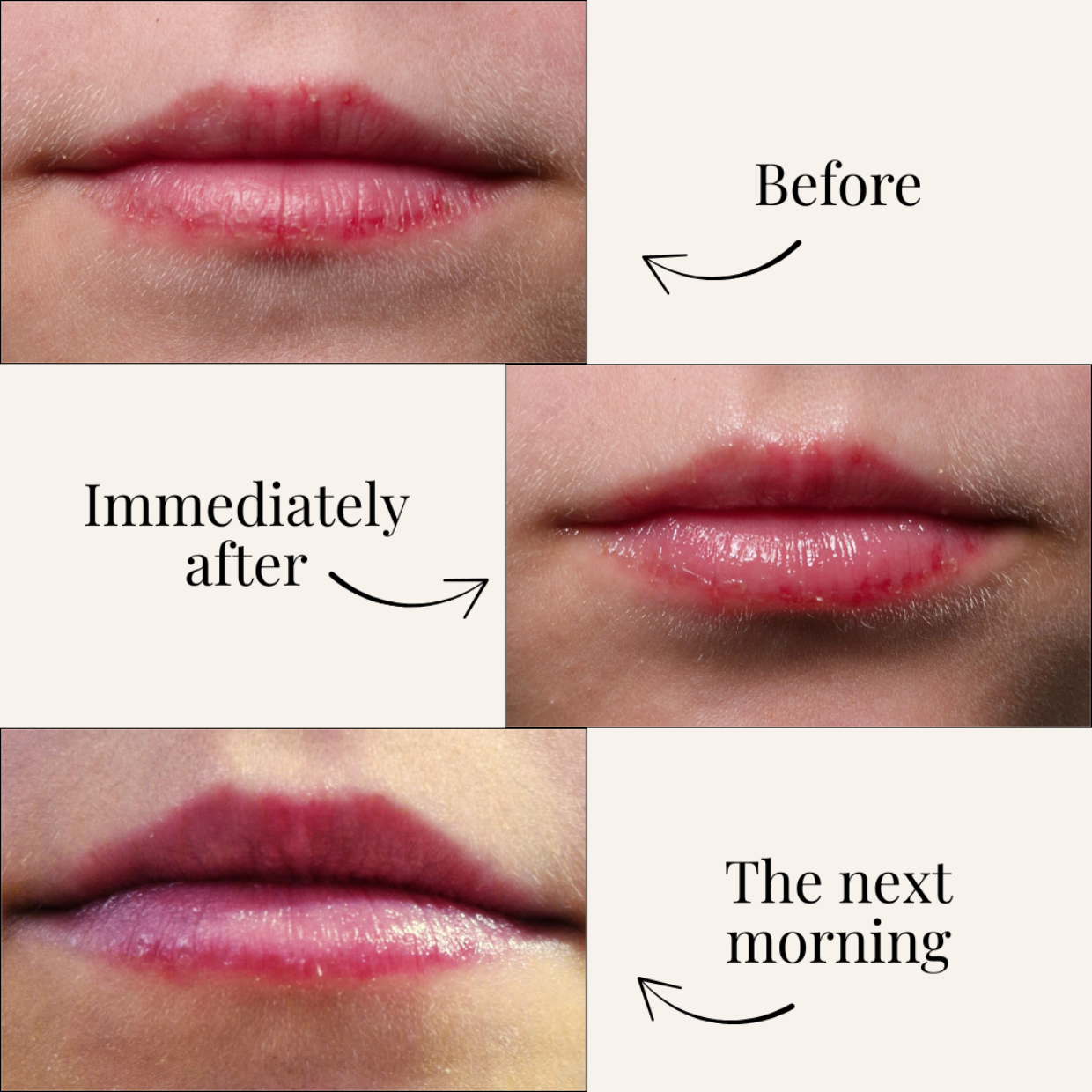 Before and after comparison of lips with text labels showing the effect over time.